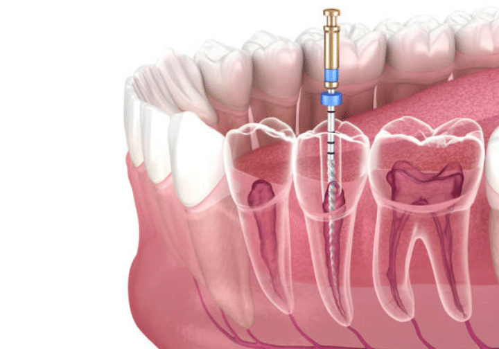 Signs You Need a Root Canal Treatment (RCT)