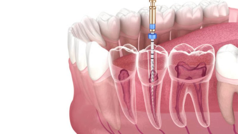 Signs You Need a Root Canal Treatment (RCT)