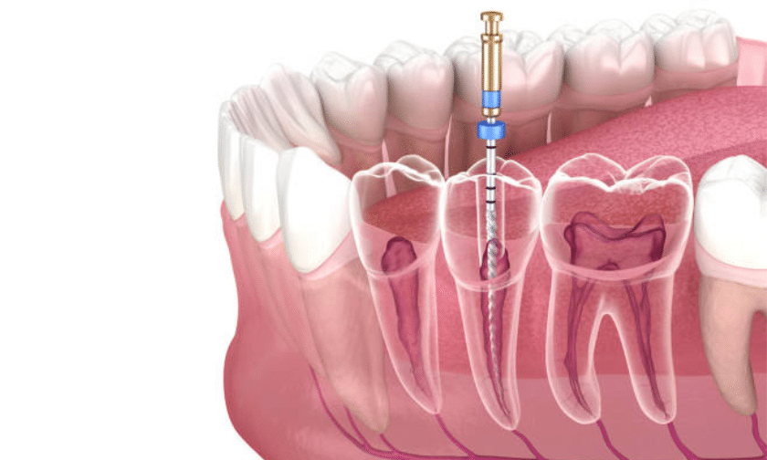 Signs You Need a Root Canal Treatment (RCT)